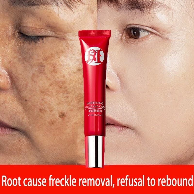 Creme forte original para remover manchas escuras/clareamento de pigmentos/cuidados com a pele QRJZ 2RWB